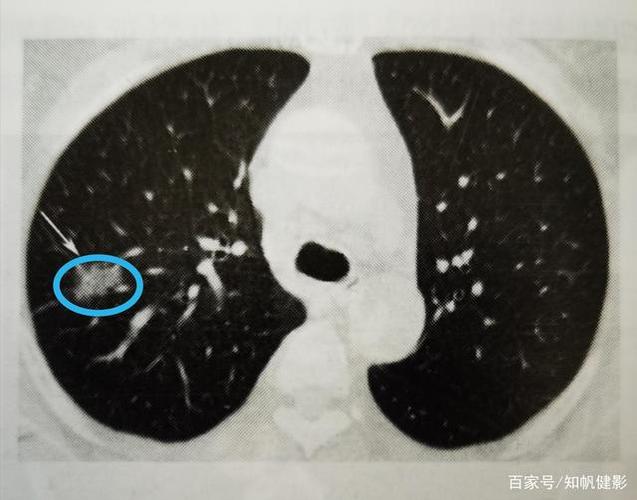 干咳两个月查出肺癌,仓配一体,时效速达