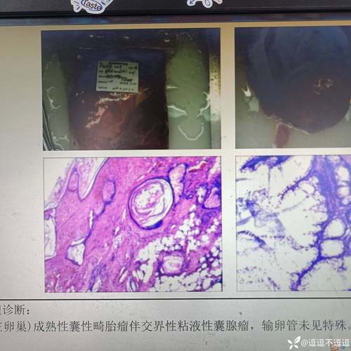 腹腔长40厘米长肿瘤,上门取货_123随叫随到